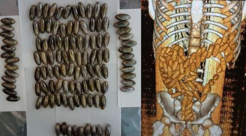 Midesinden çıkanlar şoke etti!