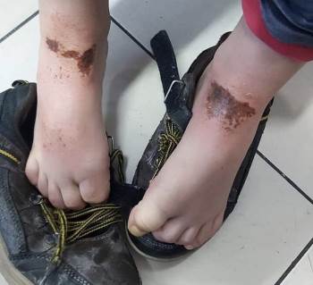 Okul Bahçesinde Oynayan Öğrencilerin Vücutlarında Oluşan Çürük Ve Yanıklar Sağlık Kuruluşları İle Belediyeyi Harekete Geçirdi
