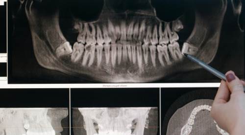 Periapikal Röntgen Nedir? Nasıl Çekilir, Farklı Çekim Türleri ve Potansiyel Zararları