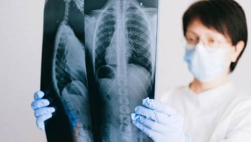 Rüyada Akciğer Kanseri Olduğunu Görmek