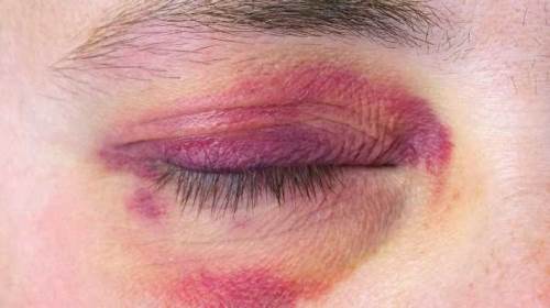 Rüyada Darbe Görmek Ne Demek?