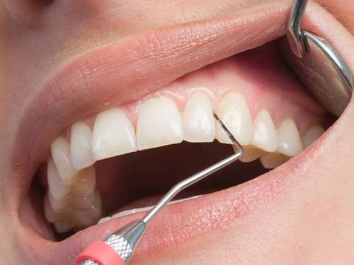 Rüyada Diş Dolgusu Düşmesi