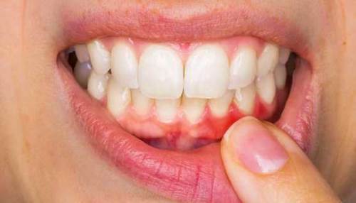 Rüyada Diş Eti Kanaması Görmek Ne Anlama Gelir?