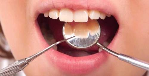 Rüyada Dişine Dolgu Yaptırmak Ne Demek?