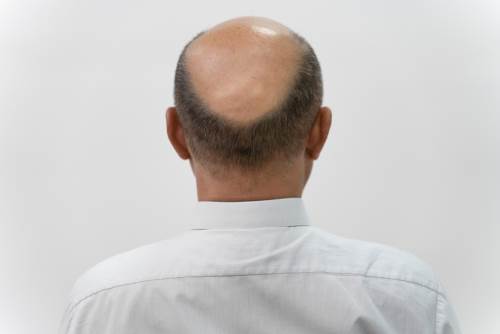  Rüyada Kel Birini Saçlı Görmek