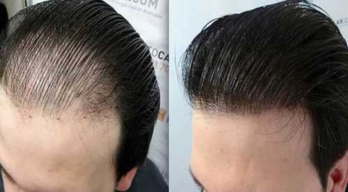 Saç ekiminde merak ettiğiniz her şey