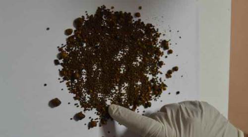 Safra kesesi değil sanki taş ocağı: Tam 4 bin 536 adet...