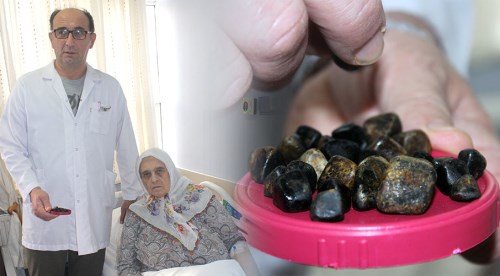 Safra kesesinden çıkanlara doktorlar bile şaştı kaldı