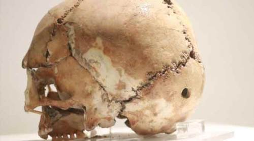 Şaşırtan keşif: 10 bin yıl önceki beyin ameliyatı...