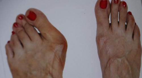 Topuklu giyenler dikkat: Parmak şekliniz bozulabilir!