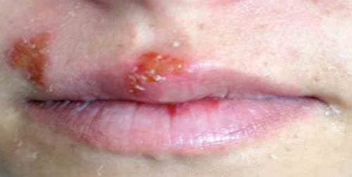 Uçuk neden çıkar? Neyi belirtisidir?