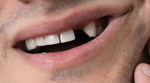 Uzak durun, dikkat: İftarda dişlerinizi kaybetmeyin!