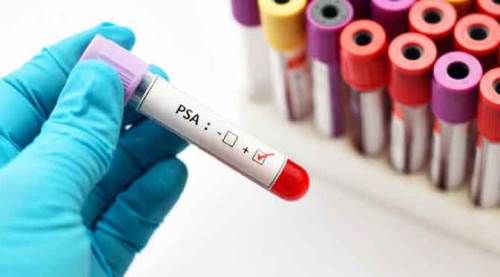 Uzmanı uyardı: 50 yaş üstü erkekler  bu testi yaptırmalı!  