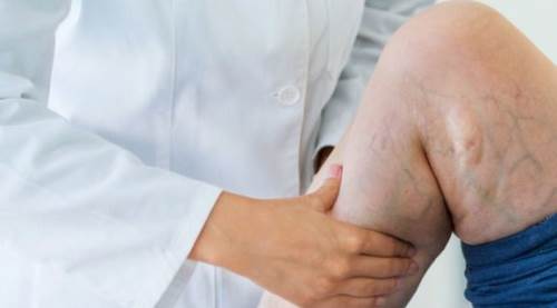 Varis Nedir? Varis Hastalığı Hakkında Detaylı Bilgiler ve Tedavi Yöntemleri