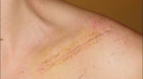 Yara izine son! İşte o müthiş buluş...