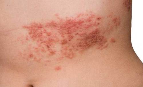 Zona hastalığında o tedavinin başarısı yüksek