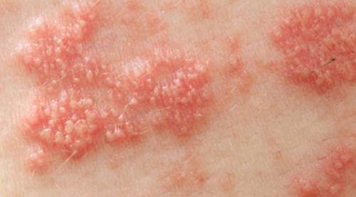 Zona Neden Olur? Zona Risk Faktörleri, Belirtileri ve Önleme Yolları