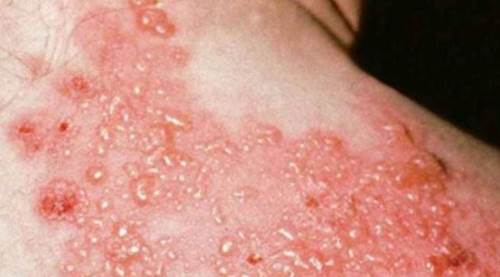 Zona sessizce geliyor: Nasıl bulaşır, su çiçeğinden farkı nedir, neden olur, tedavisi var mı?