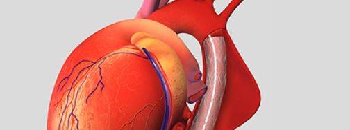 Aort yırtılması nedir, neden olur, belirtileri nelerdir?