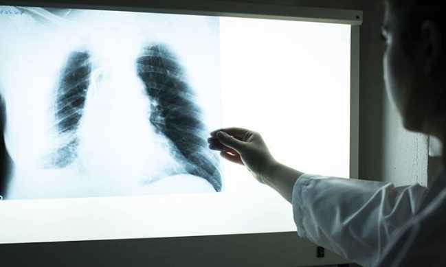 KOAH nasıl bir hastalık, belirtileri nelerdir…